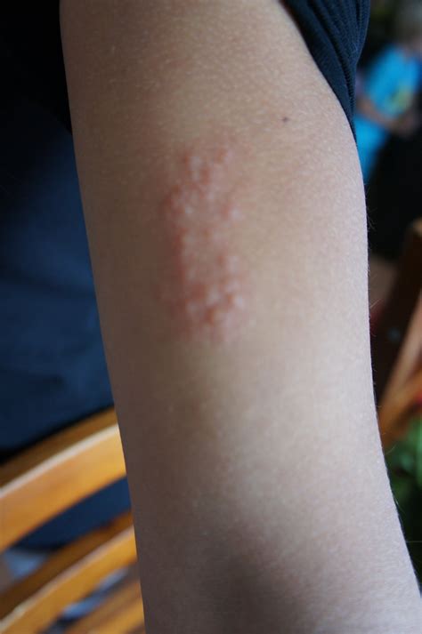 My 16 Year Old Niece Has Developed A Rash On Her Upper Arm