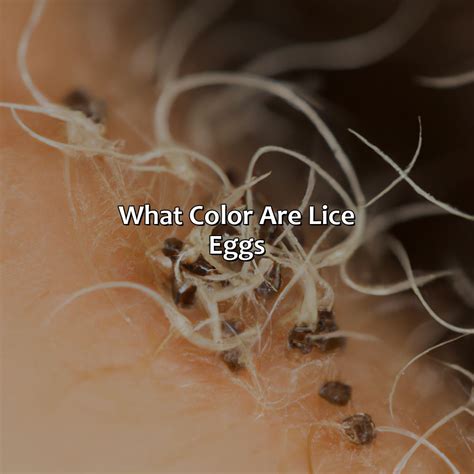 What Color Are Lice Eggs