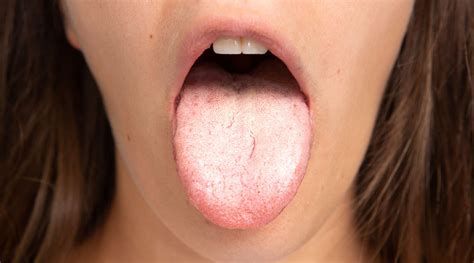 La Candidiasis Oral Causas Y Tratamiento PortalclÍnic