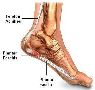 Apakah tumit anda sering terasa nyeri dan ngilu ketika berjalan atau berdiri? Apakah punca tapak kaki sebelah kanan sakit? | MrEjoy