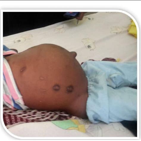 Shows Gross Abdominal Distension Cautery Marks And Umbilical Hemia