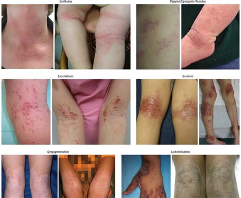 Atopic Dermatitis And Eczema Clarifying The Confusing Terminology My