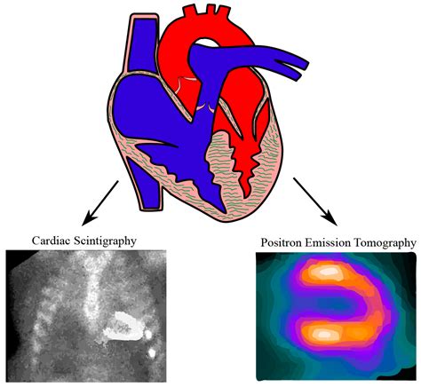 Nuclear Medicine Scan Heart