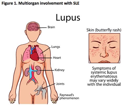 Symptoms Systemic Lupus Erythematosus Sle Including Stock 44 Off