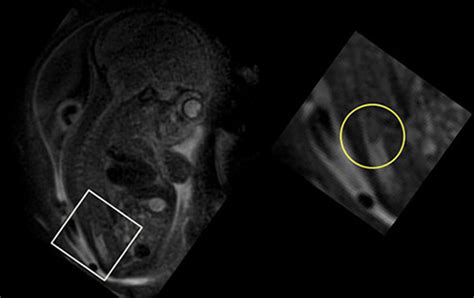 Box Inset Of Fetal Mri Is Magnified To Demonstrate Short And Blunted