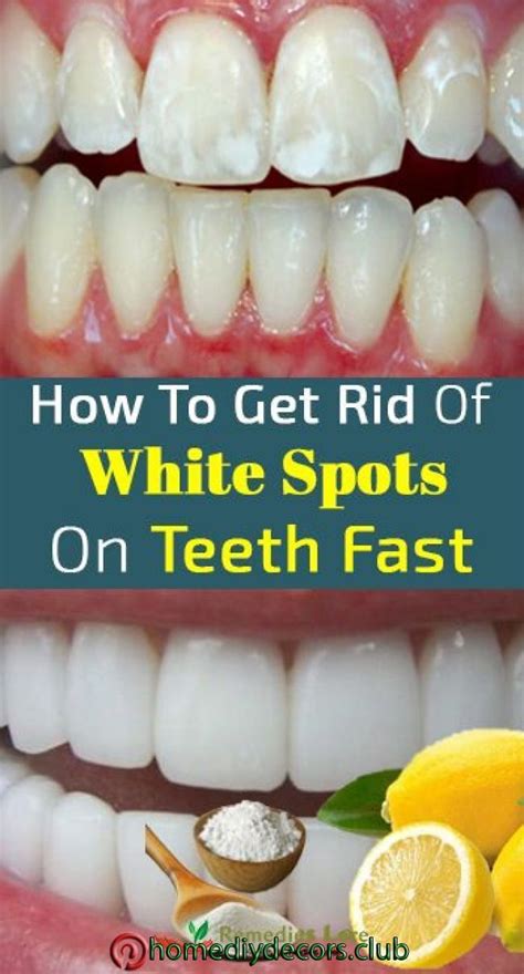 How To Get Rid Of Spots On Teeth
