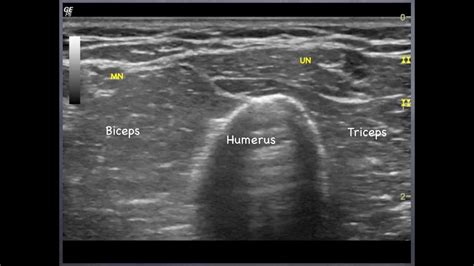 Ulnar Nerve Humerus To Elbow Sonoanatomy Qmh Aed Ultrasound