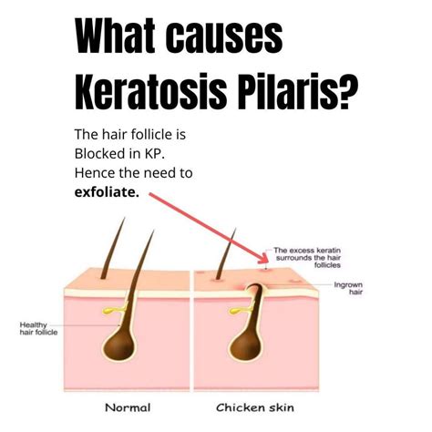 Best Keratosis Pilaris Treatment In Australia Dr Davin Lim