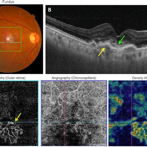 Multimodal Imaging Of An Active Type 2 Mnv A Color Fundus Photography