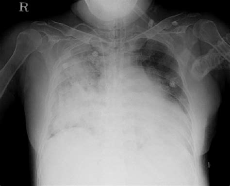 Last Follow Up Chest X Ray Shows Extensive Consolidation Of Right Lung