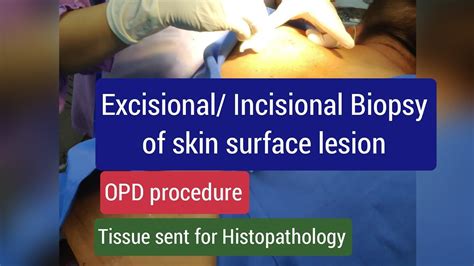 Excisional Biopsy Skin Incisional Biopsy Skin Surface Lesion Skin