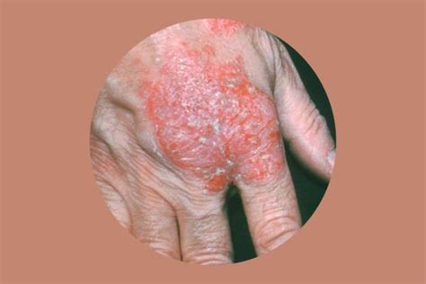 Nummular Eczema How To Get Rid Of It For Good Readers Digest