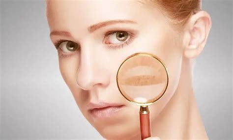 How To Cure Melasma From The Inside Learn From Experts
