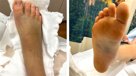 Lisfranc And Broken Foot Recovery How I Broke My Foot Headed Anywhere