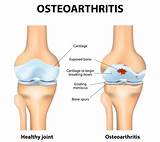 Osteoarthritis Knee Pain Home Remedies Pictures