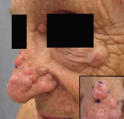 Figure 1 From Atypical Adnexal Tumors Adjacent To Basal Cell Carcinoma