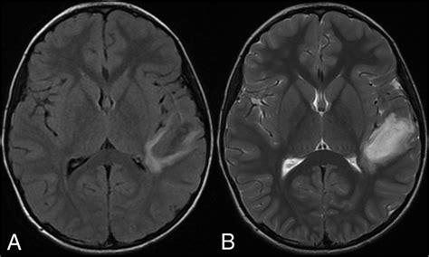 T2 Flair Mismatch Sign In Pediatric Low Grade Glioma American Journal Of Neuroradiology