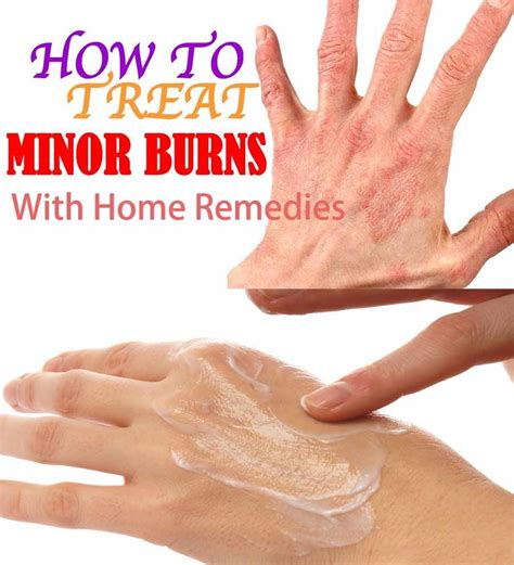 14 Home Remedies For Burn Relief Fast Home Remedies Beauty Tips Home Remedy Burns Treatment