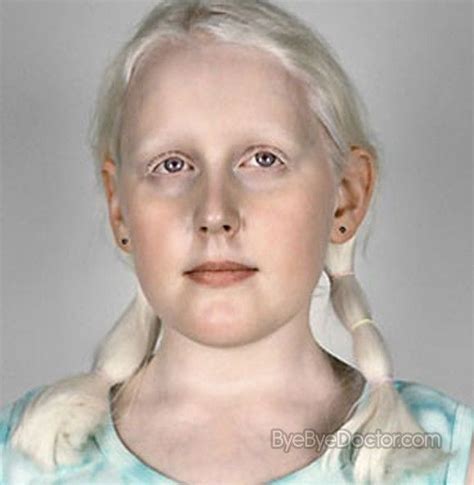 Albinism Pictures Facts Symptoms Causes Treatment Albinism