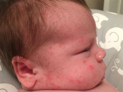 Is This Newborn Acne Or A Rash Its On Both Cheeks And His Neck Im