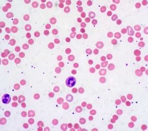 It is caused by a defect in the erythrocyte membrane, which leads to an increased permeability for sodium and water, giving the erythrocyte its typical spherical form. Spherocytosis | Ask Hematologist | Understand Hematology