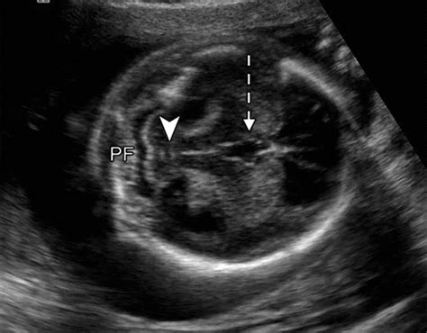 Fetal Brain Anomalies Ultrasound