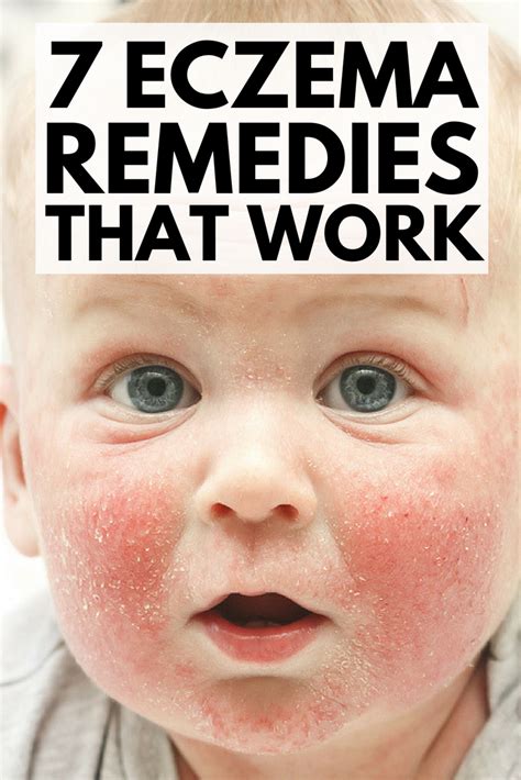 7 Eczema Remedies That Work Eczema Remedies Natural Eczema Remedies