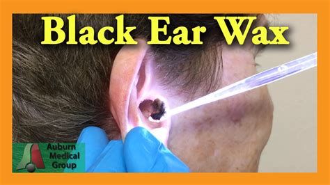 Black Ear Wax Removal Auburn Medical Group Youtube