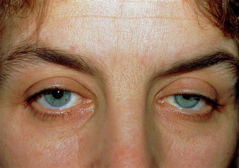 Horners Syndrome Ptosis And Constricted Pupil Photograph By Science
