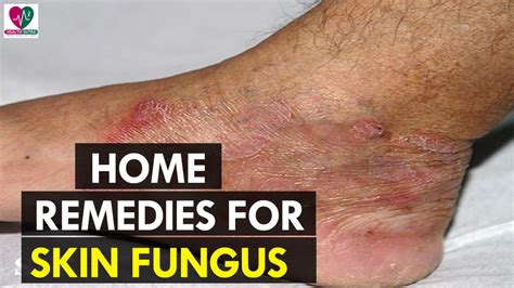 Home Remedies For Skin Fungus Health Sutra Youtube