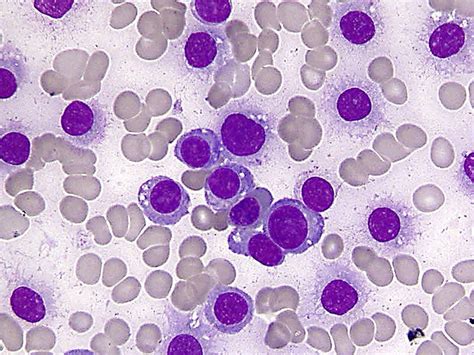 Peripheral Blood Film 90 Plasma Cells A Bluish Background Rouleaux