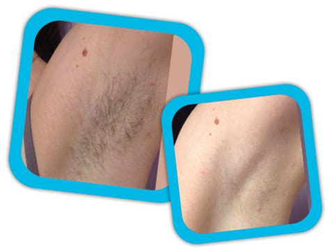 Destination treatments have begun to. Full Body Laser Hair Removal Treatment Cost in Jaipur ...