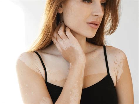 Vitiligo Causes Treatments And General Skin Care Dr Praneeth Clinic