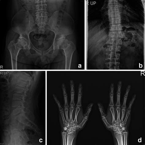 Radiographs Of Patient 3 Male Mps Iva A Ap Pelvis And Hips Age