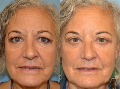 Before And After Eyelid Retraction Surgery Photos Aesthetic Surgical