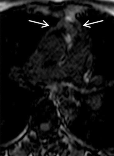 Differentiation Of Rebound And Lymphoid Thymic Hyperplasia From