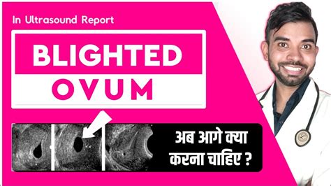Blighted Ovum Pregnancy In Hindi Blighted Ovum In Ultrasound