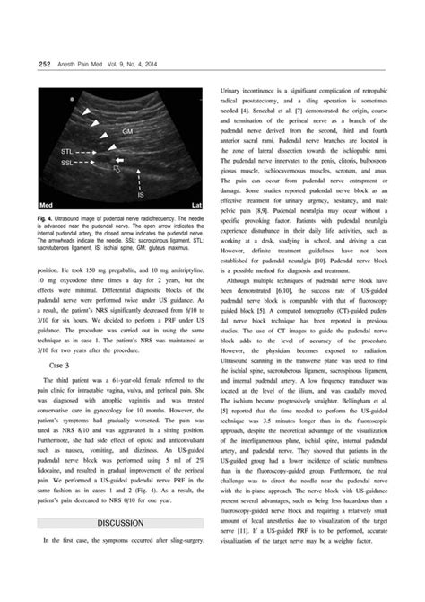 Ultrasound Guided Pudendal Nerve Pulsed Radiofrequency In Patients With