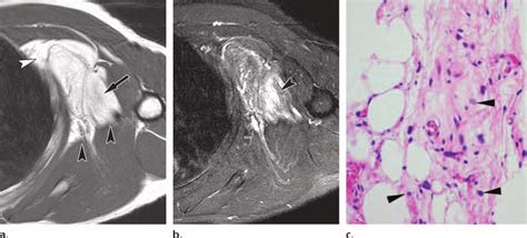 Well Differentiated Liposarcoma In A 51 Year Old Man A Axial