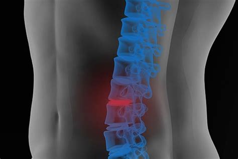 Lumbar Spine Cysts In Los Angeles Ca Intervertebral Disc Spine Health