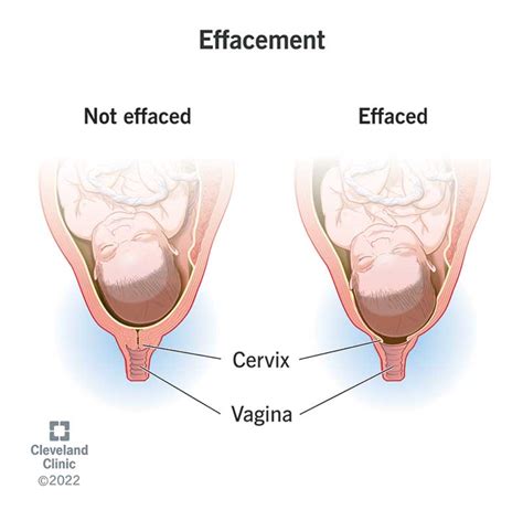 cervical effacement and dilation during labor illustration 53 off