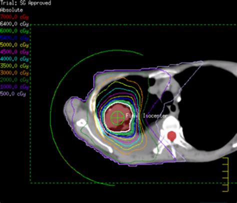Stereotactic Body Radiation Therapy Sbrt In The Management Of Pulmonary Spindle Cell Carcinoma