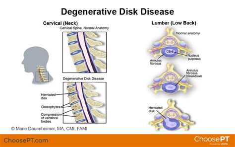 Guide Physical Therapy Guide To Degenerative Disk Disease 2023