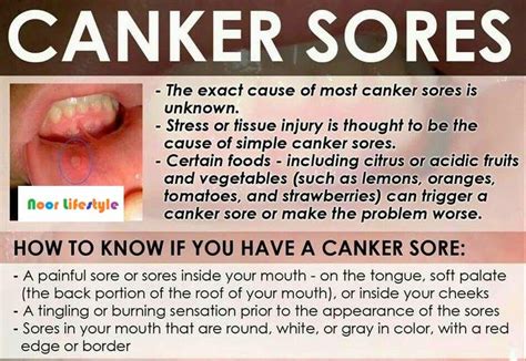 Home Remedies To Get Rid Of Canker Sores See More Details At