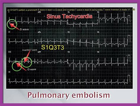 Ecg Study Cards Sinus Tachycardia Pulmonary Embolism Pulmonary