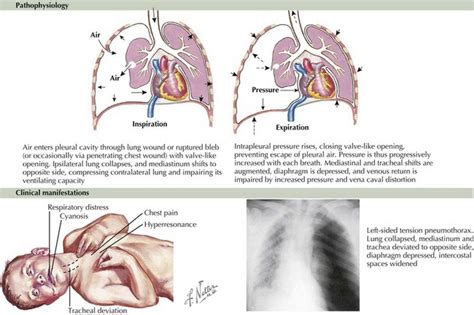 Pleural Effusions And Pneumothorax Clinical Gate