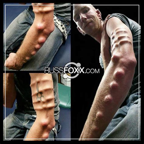 Subdermal Implants Russ Foxx