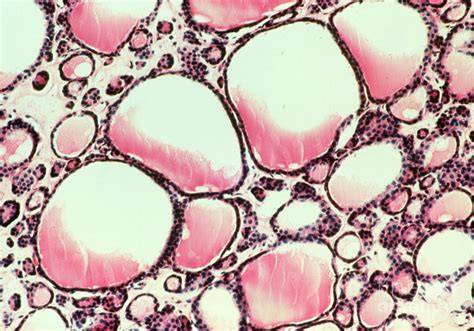 Lm Of Follicles In A Goitre Affected Thyroid Gland Photograph By Astrid