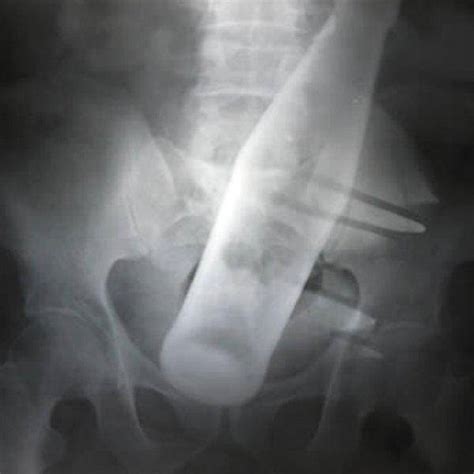X Rays Of Objects Stuck In Really Strange Places Pics Izismile Com