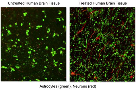 Discovery Leads To Patent For Novel Method Of Treating Traumatic Brain